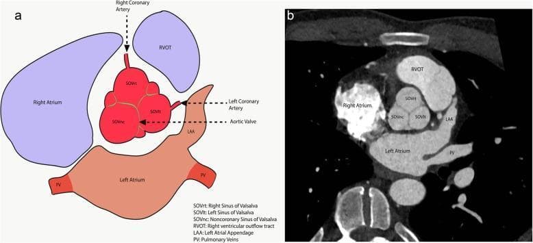 This educational image pairs an anatomical diagram (a) with a short-axis CT angiography (CTA) image (b) to illustrate the cross-sectional anatomy of the aortic root and surrounding cardiac structures. The focus is on the Sinuses of Valsalva (SOV), showing their spatial orientation and coronary artery origins. The central aortic root is divided into three distinct sinuses: the Right Sinus (SOVrt), from which the Right Coronary Artery originates; the Left Sinus (SOVlt), which gives rise to the Left Coronary Artery; and the Non-coronary Sinus (SOVnc), which lacks a coronary origin and lies adjacent to the interatrial septum. Surrounding structures are clearly labeled: the Right Ventricular Outflow Tract (RVOT) is located anteriorly and to the left; the Right Atrium is lateral to the SOVrt; the Left Atrium lies posteriorly; and the Left Atrial Appendage (LAA) and Pulmonary Veins (PV) are positioned laterally and posteriorly to the left. This material is designed for cardiovascular imaging training to aid in the precise identification of aortic root anatomy during diagnostic evaluation.