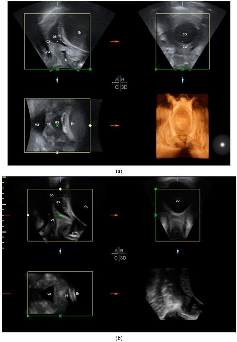 Transperineal ultrasound (TPU) compilation depicting two stages of labor progress in multiplanar views (sagittal, transverse, frontal, and 3D reconstruction). Figure (a) illustrates an earlier stage of labor where the cervix (cx) is relatively long and closed. The transverse plane clearly shows a thick cervical wall (cw) surrounding a small cervical opening (co). The sagittal view identifies the fetal head (fh), amniotic sac (as), vagina (va), urethra (u), and symphysis (s). Figure (b) demonstrates an advanced stage of labor characterized by significant cervical effacement and dilation. In the transverse plane, the cervical wall is minimally visible while the cervical opening (co) is widely dilated. The sagittal plane shows the descent of the fetal head (fh) and the amniotic sac (as) deeper into the birth canal, with the cervix (cx) appearing significantly shortened. This comparison serves as an educational tool for identifying anatomical landmarks and monitoring physiological changes such as cervical thinning and opening during the stages of delivery.