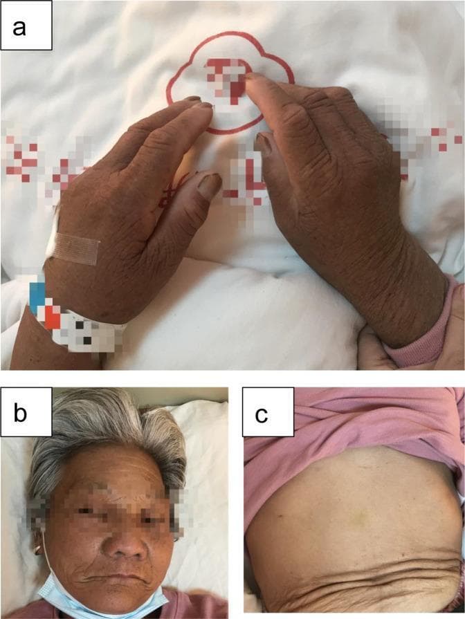 This composite of clinical photographs illustrates the dermatological manifestations of acanthosis nigricans in a patient diagnosed with Type B insulin resistance syndrome. Image (a) displays the dorsal aspect of the hands and wrists, showing significant diffuse hyperpigmentation, skin thickening, and coarsening of the skin texture (lichenification) with prominent skin folds. Image (b) shows similar hyperpigmented, velvety, and thickened skin affecting the facial region, particularly the forehead and periorbital areas. In contrast, image (c) provides a visual comparison of the abdominal skin, which lacks the intense hyperpigmentation and thickening seen on the extremities and face, though some lower abdominal skin folds are visible. These findings are characteristic of severe insulin resistance, where high circulating insulin levels stimulate keratinocytes and fibroblasts, leading to epidermal hyperplasia. The images serve as an educational example of how systemic metabolic and autoimmune disorders, such as those involving insulin receptor autoantibodies, can present with extensive cutaneous markers.