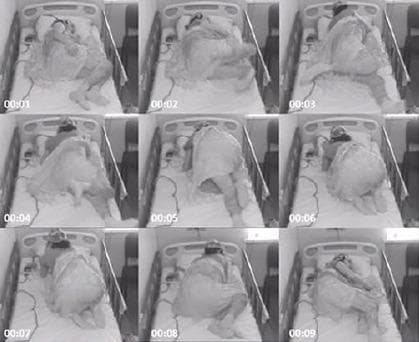 This clinical photographic sequence illustrates a focal stereotyped motor seizure captured via overnight video-EEG monitoring. The figure is presented as a 3x3 grid of grayscale frames, labeled with sequential timestamps from 00:01 to 00:09, documenting an approximately 10-second ictal event. The subject is an adult patient in a hospital bed equipped with safety rails, wearing a headwrap likely containing EEG electrodes. The sequence begins (frame 00:01) with the patient in a supine/lateral resting position. Progressive frames (00:02–00:07) demonstrate a sudden arousal followed by intense, irregular hypermotor activity involving all four limbs. The patient exhibits thrashing movements, transitioning from a recumbent position to an semi-upright, kneeling-like posture on the bed. By the final frames (00:08–00:09), the motor activity subsides as the patient returns to a resting recumbent state. This visual is representative of nocturnal frontal lobe epilepsy or similar focal seizure disorders characterized by paroxysmal motor behavior. It serves as an educational tool for identifying semiology in epileptology and clinical neurology.