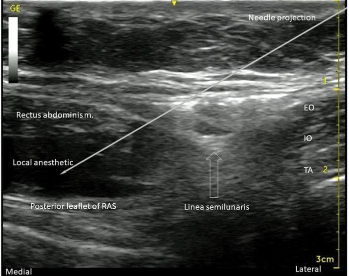 An ultrasound diagnostic image demonstrating a transversus abdominis plane (TAP) and rectus sheath block procedure. The image displays the anterolateral abdominal wall musculature in cross-section. On the right (lateral aspect), three distinct muscle layers are visible: the external oblique (EO), internal oblique (IO), and transversus abdominis (TA) muscles, separated by hyperechoic fascial planes. Progressing medially, the linea semilunaris marks the transition where these muscles meet the rectus abdominis muscle. A white line indicates the 'Needle projection,' showing an in-plane approach from lateral to medial. The needle tip terminates between the rectus abdominis muscle and the hyperechoic posterior leaflet of the rectus abdominis sheath (RAS). A significant hypoechoic (dark) area is labeled 'Local anesthetic,' illustrating the successful hydrodissection and spread of injectate within the posterior rectus sheath plane. This visual serves as a clinical guide for regional anesthesia, highlighting essential landmarks for ultrasound-guided nerve blocks of the T7-T12 intercostal nerves.