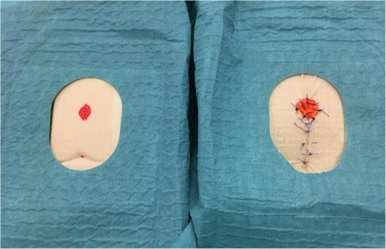 A top-down comparison photograph featuring two synthetic perineal sponge models used for surgical simulation training of the Posterior Sagittal Anorectoplasty (PSARP) procedure. Both models are oval-shaped, light peach in color, and framed by blue sterile surgical drapes. The left model represents the preoperative state, showing a smooth surface with a small, central red marking indicating the planned site for the anorectal malformation (ARM) repair. The right model represents the postoperative state, demonstrating the results of surgical intervention. Key features include an orange material at the original marking site to simulate the transposed rectum and a vertical line of blue surgical sutures extending inferiorly, representing the closure of the sagittal incision. This comparison illustrates the anatomical changes and surgical steps involved in pediatric colorectal reconstructive surgery, including sagittal incision, dissection, and anoplasty, for educational and procedural validation purposes.