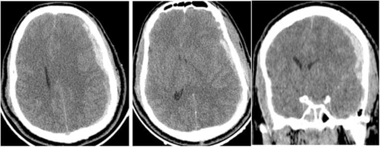 Non-contrast CT scan of the brain in axial and coronal planes demonstrating acute traumatic intracranial pathology. On the left side, there is a prominent acute subdural hematoma (ASDH) characterized by a hyperdense, crescent-shaped collection along the frontoparietal convexities. This mass effect causes significant midline shift toward the right and partial effacement of the ipsilateral lateral ventricle. Contralaterally, on the right side, a smaller hyperdense biconvex or lenticular collection is visible in the parieto-temporal region, consistent with an epidural hematoma (EDH). Additionally, a linear skull fracture is present on the right side of the skull vault. This diagnostic image illustrates the radiological features of mixed intracranial hemorrhages following severe head injury, highlighting the differential morphology between subdural (crescentic) and epidural (biconvex) blood collections and their secondary effects on brain parenchyma.
