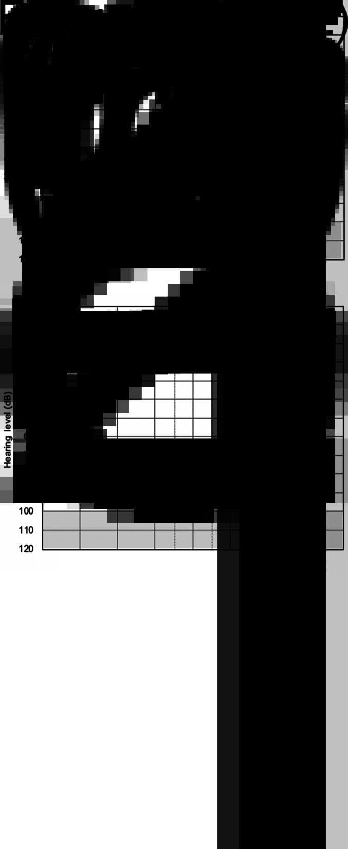This diagnostic image displays two comparative pure-tone audiograms representing initial audiology testing for the right (a) and left (b) ears. Each graph plots frequency in Hertz (Hz) on the x-axis, ranging from 125 Hz to 8000 Hz, against hearing level in decibels (dB) on the y-axis, ranging from -10 dB to 120 dB. The audiogram for the right ear (a) demonstrates a severe-to-profound high-frequency sensorineural hearing loss (SNHL), characterized by a sharp downward slope with thresholds exceeding 80-100 dB at higher frequencies. In contrast, the audiogram for the left ear (b) shows hearing thresholds within the normal to mild loss range across most frequencies, illustrating a significant asymmetrical hearing impairment. These clinical visuals are used in Otolaryngology (ENT) to diagnose and monitor auditory dysfunction, specifically identifying the severity and configuration of sensorineural hearing loss often associated with pathology or sudden onset syndromes.