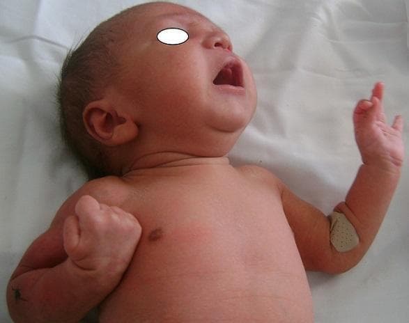 Clinical photograph of a newborn in a supine position, demonstrating asymmetrical upper limb posturing and signs of acute distress (crying). The infant's left arm is flexed at the elbow with the hand clenched in a tight fist, while the right arm is extended. A small adhesive bandage is present on the lateral aspect of the right arm just above the elbow joint. On the left forearm, a small, dark skin lesion or mark is visible. The image illustrates a clinical examination of neonatal motor function and limb symmetry, potentially related to neonatal radial nerve palsy or subcutaneous fat necrosis following a traumatic birth. The facial expression and open mouth indicate irritability or pain, which is clinically relevant when assessing painful subcutaneous nodules or nerve injuries in neonates.