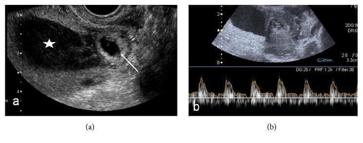 This composite diagnostic image showcases a transvaginal ultrasound (TVUS) examination of a Cesarean Scar Ectopic Pregnancy (CSEP). Panel (a) presents a sagittal grayscale ultrasound view of the uterus. A gestational sac (marked by an arrow) is seen implanted low in the uterine isthmus, specifically at the site of a previous cesarean section scar, distinct from the main endometrial cavity. The endometrial cavity itself is distended with heterogeneous, low-level echoes (marked with a star), consistent with hemorrhagic fluid. Panel (b) displays a spectral Doppler ultrasound. The top portion is a B-mode image showing the fetal pole within the eccentrically located gestational sac. The bottom portion displays a pulsatile spectral Doppler waveform, confirming viable fetal heart activity. This visual sequence is pedagogically significant for illustrating the diagnostic criteria for CSEP, emphasizing the importance of anatomical localization of the gestational sac relative to the cervical canal, endometrial cavity, and previous surgical scars.