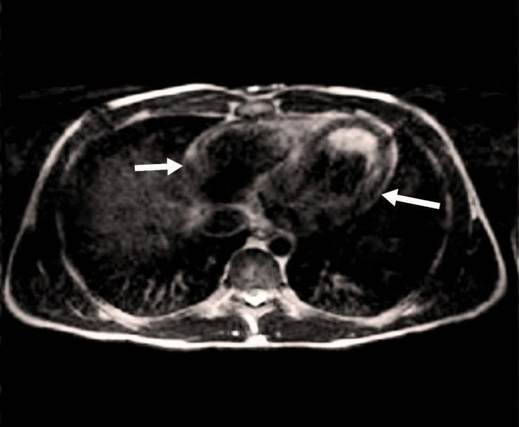 This diagnostic image is an axial T2* magnetic resonance imaging (MRI) scan of the thorax, specifically focusing on the cardiac region. The image demonstrates the heart in a cross-sectional view, surrounded by the lungs and posterior vertebral structures. Two white arrows indicate localized areas of significant low signal intensity (hypointensity) within the myocardial wall. These dark regions are characteristic of iron overload or hemosiderosis, as iron deposits cause rapid T2* relaxation and subsequent signal loss. The clinical significance of this finding relates to the assessment of cardiac iron deposition in patients with secondary hemochromatosis or chronic transfusion requirements. The lungs appear dark due to low proton density and air content, while the chest wall and subcutaneous fat provide a brighter peripheral signal. This modality is the gold standard for non-invasive quantification of myocardial iron, aiding in the diagnosis of iron-overload cardiomyopathy.