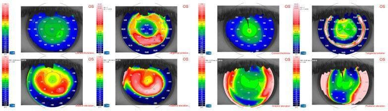 A multi-paneled corneal topography display comparing preoperative (left) and postoperative (right) states of a left eye (OS). Each state includes four distinct maps: Corneal Thickness (pachymetry), Tangential Anterior (curvature), Anterior Elevation, and Posterior Elevation. The preoperative maps show significant ectasia, characterized by irregular thinning and asymmetric areas of high elevation (warm reds/oranges) in an arcuate or spiral configuration. Postoperatively, the Tangential Anterior map demonstrates a more circular, concentric color distribution, and the elevation maps show a shift toward cooler colors (blues/greens), indicating surgical flattening and regularization of the corneal surface. Numerical values representing corneal thickness and dioptric power are overlaid on the topography. Corresponding color-coded scales are provided for each modality. This diagnostic imaging comparison illustrates the anatomical and refractive changes following a corneal procedure, likely aimed at stabilizing or correcting keratoconus or a similar ectatic disorder.
