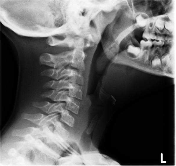 This lateral neck radiograph (X-ray) of a pediatric patient demonstrates a distinct radiopaque foreign body lodged in the upper airway. The object is oblong with tapered ends, consistent with the clinical history of a sunflower seed, and is positioned vertically within the subglottic space/upper trachea at the level of the C4-C6 cervical vertebrae. Key anatomical landmarks visible include the cervical spine with clear intervertebral spaces, the mandible, the maxilla with developing dentition, and the prevertebral soft tissues. The trachea is visualized as a radiolucent (dark) air-filled column, within which the denser foreign body is clearly contrasted. This imaging is characteristic of foreign body aspiration, illustrating its potential for upper airway obstruction. The radiograph is essential for determining the anatomical level of the obstruction to plan emergency intervention such as rigid bronchoscopy.