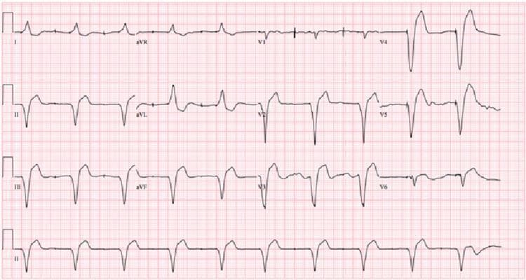 This diagnostic image is a 12-lead electrocardiogram (ECG) demonstrating a ventricular-paced rhythm. The tracing shows a consistent pattern across all leads (I-III, aVR-aVF, and V1-V6) characterized by sharp, vertical pacing artifacts (spikes) immediately preceding each QRS complex. The QRS complexes are significantly widened with a bundle branch block-like morphology, typical of ventricular depolarization originating from an artificial pacemaker electrode. In the inferior leads (II, III, aVF), the pacing spikes appear as sharp downward deflections followed by broad, slurred QRS complexes and discordant T waves. Notably, there is an absence of discernible P waves preceding the pacing spikes, indicating an underlying rhythm managed by ventricular pacing. This ECG was obtained 24 hours following treatment with Digoxin Immune Fab (DIF) for digoxin toxicity, illustrating the conversion from an unstable arrhythmia to a stable, paced rhythm in a patient with heart failure.