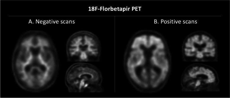 This diagnostic imaging figure displays 18F-Florbetapir Positron Emission Tomography (PET) scans of the brain, comparing amyloid-negative (A) and amyloid-positive (B) findings. Both panels include axial, coronal, and sagittal views. In Panel A (Negative scans), the radiotracer is primarily localized within the white matter, maintaining a clear visual contrast between the radiolabeled white matter and the darker, non-binding gray matter. This pattern represents the absence of significant beta-amyloid plaque deposition. In Panel B (Positive scans), there is a marked increase in tracer uptake within the cortical gray matter across the frontal, parietal, and temporal lobes, as well as the posterior cingulate cortex. This increased tracer intensity results in a loss of the normal gray-white matter contrast, as the cortical uptake matches or exceeds white matter levels. These findings are clinically significant for the pathological identification of amyloid deposition associated with Alzheimer's disease. The comparison highlights the shift from a white-matter-only distribution to a global cortical uptake pattern used in diagnostic neurology.