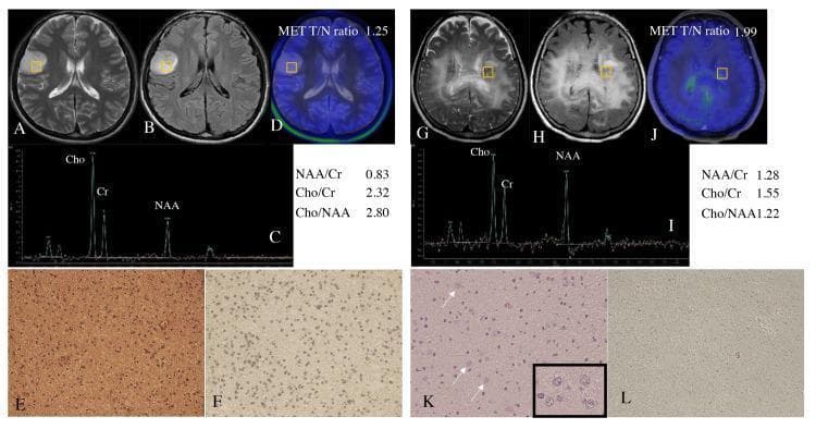 This composite figure presents a comparison between two representative cases of adult diffuse glioma, highlighting diagnostic imaging and histopathology used to determine IDH mutation status. Case 1 (A–F) demonstrates an IDH-mutant astrocytoma. Radiological findings include a well-circumscribed hyperintense lesion in the right frontal lobe on axial T2WI (A) and FLAIR (B). Magnetic resonance spectroscopy (C) shows an elevated Cho/NAA ratio (2.80), and MET-PET (D) indicates a T/N ratio of 1.25. Histology shows hypercellularity on H&E (E) and strong IDH1-R132H immunohistochemical positivity (F). Case 2 (G–L) depicts an IDH-wildtype astrocytoma with a gliomatosis cerebri pattern. Imaging (G, H) reveals diffuse, poorly demarcated bilateral involvement of the periventricular white matter. Spectroscopy (I) shows a lower Cho/NAA ratio (1.22), while MET-PET (J) shows a higher T/N ratio (1.99). H&E staining (K) reveals scattered ganglion-like cells (arrows/inset), and immunohistochemistry (L) confirms IDH-wildtype status via immune-negativity. This comparison illustrates the correlation between radiological margins, metabolic ratios, and molecular markers in glioma classification.