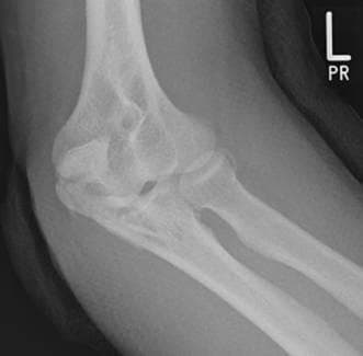 A diagnostic radiograph (X-ray) of the left elbow in an oblique view, demonstrating a comminuted fracture of the proximal ulna involving the olecranon process. The image reveals at least two distinct fracture lines, resulting in a multi-fragmentary pattern. A primary transverse fracture line extends across the olecranon, accompanied by distraction and displacement of the proximal fragment. A second fracture line indicates the presence of an intermediate fragment, which compromises the articular surface of the trochlear notch. The fracture pattern suggests a loss of structural integrity of the elbow's primary bony stabilizer against posterior displacement. Key anatomical landmarks visible include the distal humerus, the coronoid process of the ulna, and the radial head. This imaging illustrates the difficulty in detecting specific intermediate 'key' fragments using conventional biplanar radiography alone, highlighting the clinical relevance of orthopedic assessment for joint congruity and surgical planning.