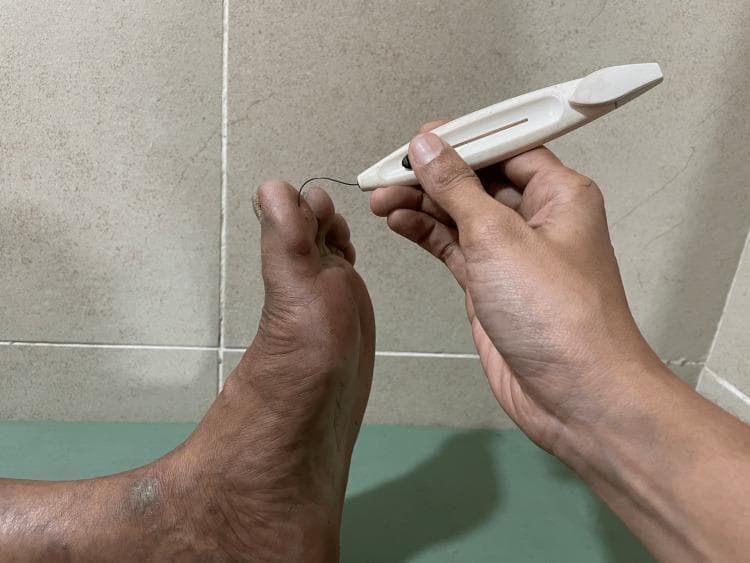 Clinical photograph of a sensory assessment being performed on a human foot using a 5.07 Semmes-Weinstein 10 g monofilament. The image shows a clinician's hand holding a white plastic monofilament device, applying the thin black filament to the dorsal surface of the distal hallux (big toe). The filament is buckled into a characteristic 'C' shape, indicating that exactly 10 g of pressure is being applied to test for Loss of Protective Sensation (LOPS). The foot exhibits several clinical signs associated with diabetic peripheral neuropathy, including skin dryness, hyperpigmentation, and a scaly, hyperkeratotic lesion near the lateral malleolus. The toenails appear thickened and dystrophic. This procedure is a critical screening tool for identifying patients at high risk for diabetic foot ulceration and neuropathic complications.