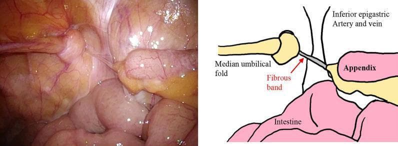 Laparoscopic view and corresponding schematic diagram of the right lower abdominal cavity demonstrating findings related to a de Garengeot hernia. The image shows the median umbilical fold incarcerated within the right femoral ring. A vermiform appendix is visible within the free abdominal cavity; notably, it exhibits a normal appearance with no signs of inflammation, enlargement, or hyperemia. A distinct fibrous band is seen connecting the tip of the appendix to the right femoral ring, indicating a prior or transient incarceration of the appendix. Surrounding anatomical landmarks include the inferior epigastric artery and vein, and loops of the small intestine. This visual illustrates a rare clinical scenario where the appendix is associated with a femoral hernia (de Garengeot hernia) but is found in a reduced state during surgical intervention. The diagram labels these structures to facilitate anatomical identification for educational purposes in general surgery and hernia repair training.