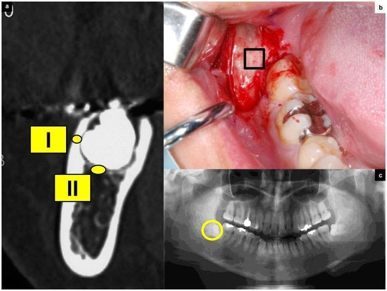 This composite image illustrates the preoperative evaluation and surgical management of an impacted mandibular third molar. (a) A cross-sectional Computed Tomography (CT) scan of the mandible identifies two regions of interest: (I) the high-density buccal cortical bone and (II) the less dense, trabecular cancellous bone adjacent to the tooth crown. (b) An intraoperative clinical photograph shows an envelope flap reflection, exposing the alveolar bone on the buccal aspect of the impacted tooth, with a rectangular marker indicating the site for a bone biopsy. (c) An orthopantomograph (panoramic X-ray) provides a broad view of the dentition, highlighting the impacted third molar (circled) and its spatial orientation within the posterior mandible relative to the second molar and the mandibular canal. This material is designed for dental education, specifically focusing on oral and maxillofacial surgery, radiographic anatomy, and the assessment of bone density (Hounsfield units) in relation to surgical extraction procedures and bone quality pathology.