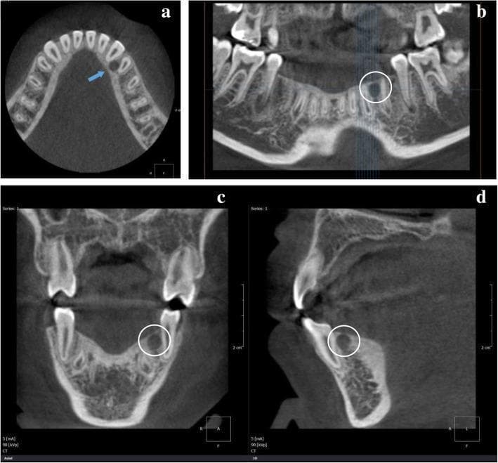 This composite image presents multiple radiographic views of a Primordial Odontogenic Tumor (POT) in the mandible. Panel (a) shows an axial cone-beam CT (CBCT) scan highlighting a small, approximately 5mm, well-circumscribed round radiolucent cavity with a distinct cortical border (indicated by a blue arrow) located mesiolingual to the root of the mandibular left first premolar (tooth 34). Panels (b), (c), and (d) provide panoramic and cross-sectional reconstructions that further illustrate the lesion (marked by white circles). The panoramic view reveals a well-defined radiolucency in the left mandibular body, while the adjacent periapical region shows evidence of bone resorption and reactive sclerosing osteitis. Unlike typical odontogenic tumors that appear pericoronally with unerupted teeth, this specific presentation (Type C) demonstrates a rare localization in close proximity to the root of a fully erupted tooth. The imaging highlights key diagnostic features including unilocular morphology, cortical expansion without perforation, and its relationship to the surrounding dentition.
