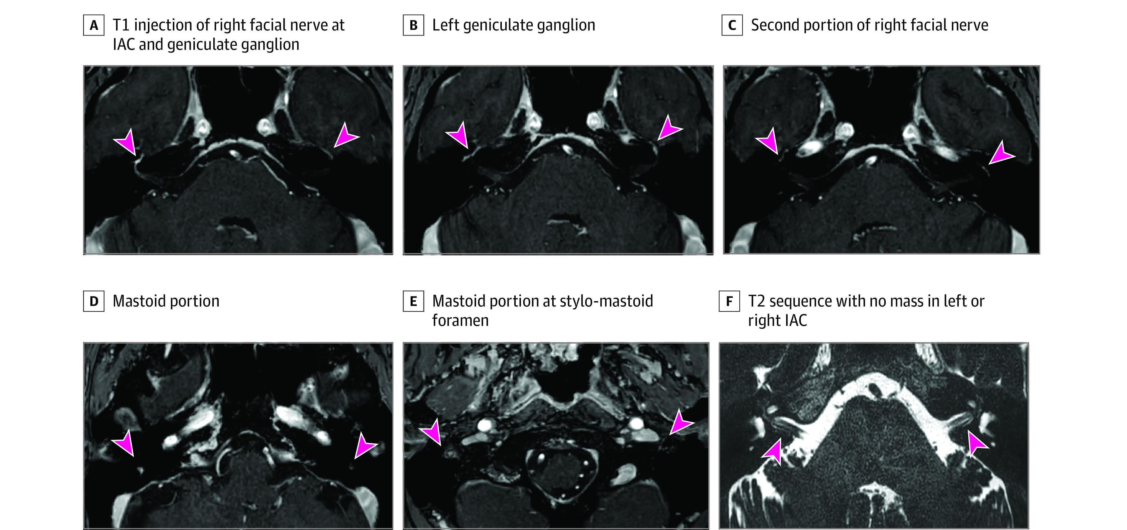 This set of six axial MRI images (A-F) illustrates the diagnostic imaging findings of idiopathic peripheral facial palsy (Bell's palsy) in a middle-aged patient. Images A through E are T1-weighted sequences following gadolinium administration, demonstrating nonnodular hyperintensity and contrast enhancement of the right facial nerve across various segments. Specific anatomical regions highlighted by pink arrowheads include the internal auditory canal (IAC), the geniculate ganglion, the tympanic (second) portion, the mastoid (third) portion, and the nerve's exit at the stylomastoid foramen. The left facial nerve is indicated for side-by-side comparison, showing normal, minimal-to-no contrast uptake. Image F is a submillimeter-resolution T2-weighted sequence used to rule out compressive lesions or masses, showing a clear, unobstructed internal auditory canal bilaterally. The clinical significance of these findings is to confirm facial nerve neuritis while excluding alternative etiologies like vestibular schwannoma or lymphoma.