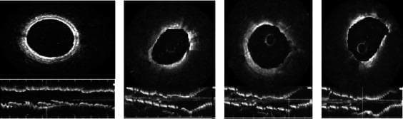 This diagnostic image provides a side-by-side comparison of intravascular optical coherence tomography (OCT) scans of coronary arteries. Panel (a) displays a healthy coronary artery, characterized by a smooth, circular lumen and a clearly defined three-layer vascular wall structure consisting of the intima (bright signal), media (dark band), and adventitia (outer bright layer). Panels (b), (c), and (d) depict clinical manifestations of unstable angina pectoris in a 67-year-old male. These pathological scans demonstrate irregular lumen morphology, heterogeneous signal intensity, and arterial wall thickening. Specific findings include high-intensity dot-like and strip-like structures consistent with macrophage infiltration and areas of signal attenuation indicative of atherosclerotic plaque. The bottom sections of each panel provide longitudinal reconstructions (L-mode), further highlighting the contrast between the uniform, layered architecture of the healthy vessel and the disrupted, irregular vessel wall topography associated with coronary artery disease and unstable plaque. This comparison is used to educate on the identification of vulnerable plaque features and thrombus formation in interventional cardiology.