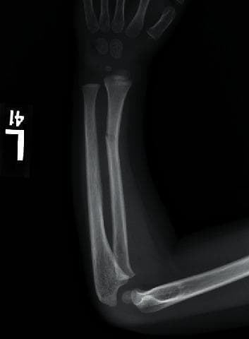 A diagnostic X-ray (radiography) of the pediatric left forearm in a lateral-oblique view. The image depicts the humerus, radius, and ulna, as well as several carpal and metacarpal bones. A greenstick fracture is clearly visible in the distal third of the radial diaphysis. The fracture presents as an incomplete cortical disruption on the dorsal aspect with bowing of the opposite cortex, characteristic of pediatric skeletal flexibility. There is minimal volar angulation of the distal fragment, and no significant displacement is observed. The adjacent ulna remains intact without evidence of plastic deformation or fracture. The presence of visible growth plates (physes) at the distal radius, ulna, and proximal humerus confirms the pediatric nature of the patient. This radiograph is an educational example of common pediatric musculoskeletal trauma resulting from low-energy mechanisms like a fall on an outstretched hand (FOOSH).