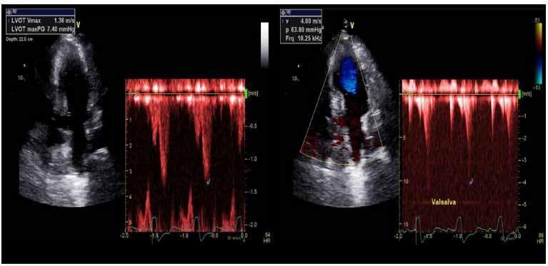 Diagnostic ultrasound imaging displaying two side-by-side transthoracic echocardiogram panels (apical four-chamber view) with continuous-wave spectral Doppler tracings, illustrating the hemodynamics of hypertrophic cardiomyopathy. The left panel shows resting state measurements of the left ventricular outflow tract (LVOT) with a peak velocity (Vmax) of 1.36 m/s and a maximum pressure gradient (maxPG) of 7.40 mmHg, reflected in a relatively thin and low-amplitude spectral Doppler waveform. The right panel demonstrates the effects of a Valsalva maneuver, showing a significant increase in flow velocity to 4.00 m/s and a pressure gradient of 63.90 mmHg. Visually, the right panel features blue color Doppler flow in the LVOT indicating high-velocity flow away from the transducer and a markedly denser, higher-amplitude spectral Doppler envelope with a late-peaking 'dagger-shaped' morphology characteristic of dynamic LVOT obstruction (LVOTO). This comparison provides a clinical demonstration of provocable obstruction used in the diagnostic workup of obstructive cardiomyopathy.