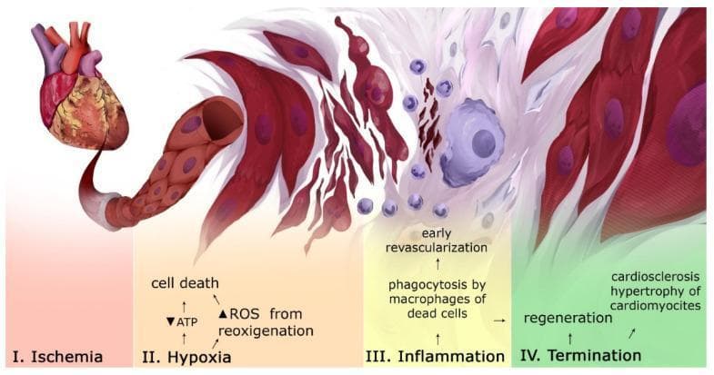 This pathophysiology diagram illustrates the chronological progression of tissue and cellular events following a myocardial infarction (MI), divided into four distinct stages. Stage I (Ischemia) shows an intact heart model. Stage II (Hypoxia) depicts the onset of cell death characterized by decreased ATP and increased reactive oxygen species (ROS) during reoxygenation, showing irregular, red-colored cardiomyocytes adjacent to a damaged capillary. Stage III (Inflammation) visualizes the early revascularization and immune response, including the phagocytosis of dead cell debris by macrophages (large irregular purple cells) and the infiltration of smaller leukocytes. Stage IV (Termination/Reparative phase) demonstrates myocardial regeneration and cardiosclerosis, where dead cells are replaced by dense white fibrous tissue (scarring) and surviving cardiomyocytes exhibit hypertrophy and more organized alignment. This educational infographic captures the transition from acute ischemic injury through the inflammatory cascade to chronic tissue remodeling and fibrosis, relevant for cardiovascular pathology and rehabilitative medicine study.