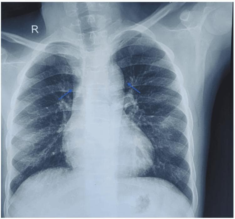 This diagnostic image is a posteroanterior (PA) chest radiograph demonstrating classic cardiac and vascular findings associated with cyanotic congenital heart disease, specifically Tetralogy of Fallot. Key anatomical observations include a prominently enlarged ascending aorta and a distinct concavity in the region of the main pulmonary artery segment (pulmonary conus). The cardiac silhouette shows an upturned apex, characteristic of right ventricular hypertrophy, which contributes to a 'boot-shaped' heart appearance (coeur en sabot). Blue arrows highlight the mediastinal contours and pulmonary vasculature. The lung fields appear relatively oligemic, consistent with decreased pulmonary blood flow. No acute consolidations, pleural effusions, or signs of congestive heart failure are visible. The clinical significance of these findings lies in illustrating the structural remodeling of the heart and great vessels resulting from right ventricular outflow tract obstruction and a right-to-left shunt.