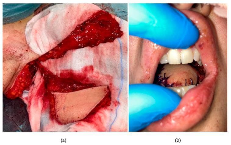 Clinical intraoperative photographs detailing a chimeric free-flap reconstructive procedure for a glossectomy defect. Figure (a) displays a macro view of a latissimus dorsi myo-fascio-cutaneous free flap harvested on a right thoraco-dorsal pedicle. The image shows a highly vascularized, red muscular component (latissimus dorsi) and a distinct, pale, avascular fascial component (serratus anterior) laid out on surgical gauze for inspection prior to transfer. Figure (b) shows the final intraoperative result within the oral cavity. The pale, bulkier myocutaneous component has been used for total tongue reconstruction, while the chimeric fascial component resurfaces the floor of the mouth and tonsillar fossa. The reconstruction is secured with visible black interrupted sutures. Clinical signs of immediate post-operative changes include mild swelling of the flap and minor serosanguinous fluid along the suture lines. This visual material demonstrates advanced microsurgical reconstruction techniques in head and neck oncology, specifically for speech and swallow function restoration following extensive tongue resection.