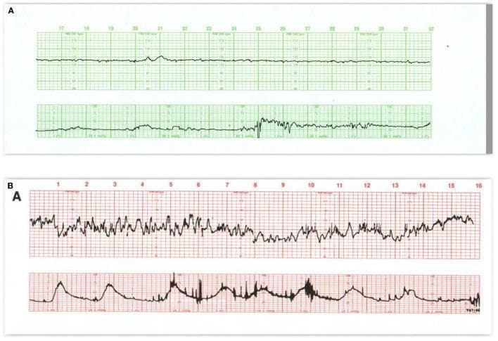 This diagnostic image displays two comparative cardiotocography (CTG) tracings monitoring fetal heart rate (FHR) and uterine contractions during labor. Panel A (top, green grid) illustrates a pattern of diminished baseline FHR variability, often associated with maternal narcotic administration. The FHR tracing shows minimal beat-to-beat fluctuations and small accelerations that occur primarily in synchronization with uterine contractions, which are depicted on the lower channel. Panel B (bottom, red grid) demonstrates a 'saltatory' pattern characterized by exaggerated, high-amplitude FHR variability (exceeding 25 bpm). The uterine contraction channel below it shows frequent activity. Between the 5-minute and 10-minute markers, a prolonged, erratic deceleration in the FHR is visible, representing a fetal response to excessive uterine activity or subacute hypoxia. Following this event, the FHR baseline briefly exceeds its previous level during recovery. These tracings serve as educational tools for distinguishing between pharmacologically induced FHR changes and autonomic stress responses to uterine hyperstimulation.