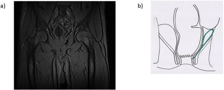 This composite educational graphic details a supralevator abscess through diagnostic imaging and anatomical illustration. Image (a) is a coronal T2-weighted magnetic resonance image (MRI) of the male pelvis, showing a hyperintense fluid collection measuring approximately 6x2x3 cm located superior to the levator ani muscle. This collection is positioned laterally to the rectum and adjacent to the prostatic region and internal obturator muscle, with an associated inter-sphincteric fistula tract extending inferiorly. Image (b) provides a schematic coronal diagram of the anorectal region, highlighting the abscess in green. The illustration depicts the anatomical relationship between the abscess, the levator ani muscle, and the anal sphincters. It clearly shows the fistulous communication originating from the supralevator space and tracking through the inter-sphincteric plane toward the anal canal. These images together demonstrate a complex perianal infection, which is a critical diagnostic finding in colorectal surgery for determining surgical drainage approaches and identifying potential internal fistula openings.