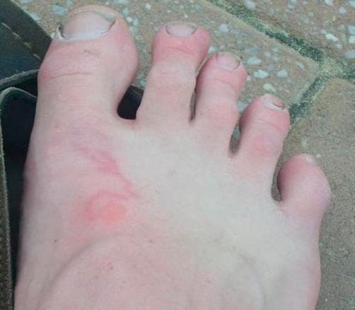 This clinical photograph shows the dorsum of a right foot of a fair-skinned individual, illustrating a classic presentation of Cutaneous Larva Migrans. The primary lesion is a thin, erythematous, and raised serpiginous (snake-like) track that winds across the mid-dorsal surface. The track is approximately 2-3 mm wide and exhibits a migratory, linear, and wavy morphology characteristic of a creeping eruption caused by hookworm larvae. At one end of the track, there is a more concentrated circular erythematous patch, possibly representing the initial site of larval penetration or a localized inflammatory response. The surrounding skin appears normal without secondary infection signs like purulence or significant edema. The toes, nails, and general skin texture are visible and unremarkable except for the parasitic track. This image is an educational example of tropical dermatology, highlighting a diagnostic visual sign for a parasitic infestation typically acquired through contact with contaminated sand or soil.