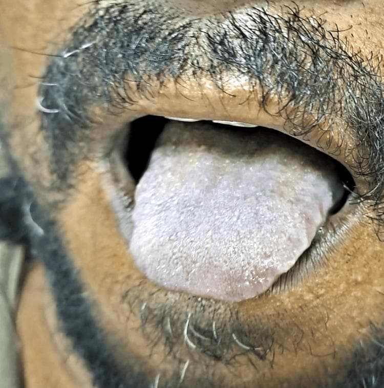 This clinical photograph shows a close-up view of a patient's open mouth, focusing on the dorsal surface of the tongue protruding slightly. The tongue exhibits a prominent bluish-slate discoloration, a classic clinical sign of central cyanosis. The surface texture of the tongue appears normal with visible lingual papillae, but the diffuse blue-grey hue indicates a systemic reduction in oxygenated hemoglobin or the presence of abnormal hemoglobin variants. In this clinical context, the presentation is characteristic of methemoglobinemia, a condition where hemoglobin is oxidized to methemoglobin, which cannot bind oxygen. The surrounding perioral skin and lips show a natural brown pigmentation and dark facial hair, providing a stark color contrast to the abnormal hue of the mucous membrane. This image serves as an educational example for identifying central cyanosis and differentiating it from peripheral cyanosis, emphasizing the importance of examining highly vascularized mucosal surfaces in patients with suspected hypoxemia or toxic ingestions.