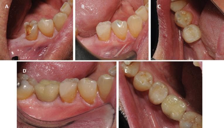A series of five intraoral clinical photographs documenting the restorative treatment of a right mandibular second premolar (tooth 45). Image A displays the initial presentation from a vestibular (buccal) view, revealing a significant loss of tooth structure involving the disto-vestibular and occlusal walls, consistent with a failed restoration or extensive caries. The adjacent gingiva shows localized hyperemia and inflammation. Images B (vestibular) and C (occlusal) show the immediate postoperative result of the restoration using aesthetic micro-hybrid composite resin. The restoration successfully anatomically reconstructs the cusps and marginal ridges with a high-luster polish. Images D (vestibular) and E (occlusal) provide a one-and-a-half-year follow-up, demonstrating the clinical longevity of the restoration. In this long-term view, the composite material shows slight color maturation and minor surface wear, yet maintains good marginal integrity and anatomical form. An implant-supported crown is also visible in the adjacent tooth 46 position in the follow-up images.