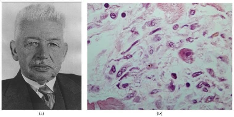 This composite image includes a portrait of Karl Albert Ludwig Aschoff and a high-magnification histological micrograph of a myocardial tissue section stained with Haematoxylin and Eosin (H&E). The micrograph (b) demonstrates the characteristic pathognomonic features of rheumatic myocarditis. It displays a granulomatous 'Aschoff body' within the cardiac interstitium. Key cellular components visible include 'Aschoff cells'—large, multinucleated or mononucleated cells with abundant eosinophilic cytoplasm and prominent 'owl-eye' nucleoli—and 'Anitschkow cells'. The Anitschkow cells, also known as 'caterpillar cells', are identified by their elongated nuclei with a central band of chromatin and fine lateral projections. The surrounding myocardial matrix shows interstitial edema and a mixed inflammatory infiltrate. This image is an essential educational resource for pathology and cardiology, illustrating the classic histopathological hallmarks used to diagnose acute rheumatic fever and its manifestation in the heart muscle.