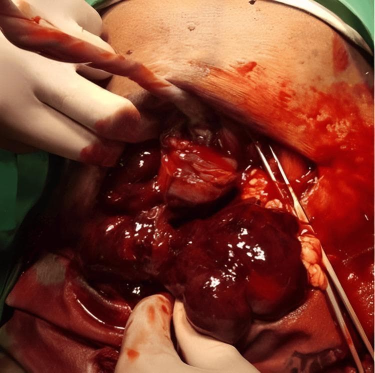 This clinical photograph captures an intraoperative view of a cesarean section complicated by placental abruption. The primary visual focus is on the uterus, which demonstrates the characteristic features of a Couvelaire uterus, also known as uteroplacental apoplexy. The myometrium appears dark, bluish-purple, and severely congested due to the widespread extravasation of blood into the uterine musculature. An incision in the uterine wall reveals a significant accumulation of dark red blood and organized clots within the hysterotomy site. The surgical field is heavily blood-stained, indicating active hemorrhage or hemoperitoneum. Gloved hands are seen manipulating the tissues, and surgical instruments, including forceps, are visible within the abdominal cavity. The umbilical cord is also seen emerging from the surgical site. This image serves as a clear educational example of the gross pathological appearance of uterine ecchymosis following severe abruptio placentae, highlighting the critical nature of obstetric hemorrhage and the visual markers of impaired uterine contractility in this clinical scenario.