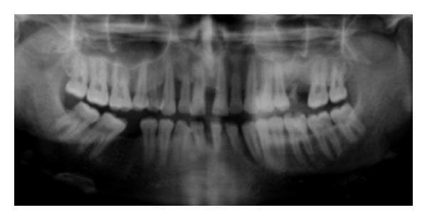 This orthopantomogram (OPG) provides a comprehensive radiographic view of the maxilla and mandible, illustrating advanced generalized periodontal disease. The primary clinical finding is widespread, severe alveolar bone loss affecting both arches. The bone destruction presents as a combination of horizontal resorption and significant vertical (angular) defects. Notably, teeth 13 (maxillary right canine) and 33 (mandibular left canine) demonstrate advanced vertical bone defects characterized by deep, narrow radiolucent areas extending apically along the root surfaces. The alveolar crest appears irregular and uneven throughout, with varying bone density indicative of active resorption and loss of cortical plate integrity. Multiple teeth exhibit increased spacing (pathologic migration) and secondary signs of clinical attachment loss. The maxillary sinuses and mandibular canals are visible as landmarks. This imaging is diagnostic for generalized aggressive periodontitis, emphasizing the pattern of destruction in a potentially young patient where the severity of bone loss is disproportionate to local factors like plaque or calculus.