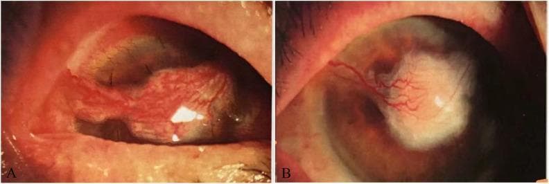 This clinical photograph set displays two chronological stages of postoperative healing in a patient with Mycobacterium avium keratitis of the right eye. Panel (A), taken 13 days post-surgery, illustrates a bridge conjunctival flap successfully covering a central corneal ulcer. The flap appears as a hypervascular, reddish, and textured tissue bridge secured over the cornea, accompanied by significant mixed conjunctival congestion and perilimbal hyperplasia. Panel (B), taken 49 days post-surgery, shows the subsequent progression and resolution. The bulky conjunctival flap is no longer present; instead, there is a central area of white corneal opacification (scarring) representing the healed ulcer site. Vascularization is still visible extending toward the lesion, but the overall conjunctival redness and inflammation have markedly subsided. The images demonstrate the surgical management of refractory mycobacterial keratitis through anterior chamber irrigation and autologous conjunctival flap grafting to promote ocular surface stability and structural healing.