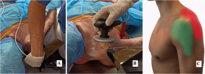 This composite educational image illustrates electrode placement for capacitive-resistive electric transfer (TECAR) therapy on the shoulder region. Panel A shows a clinical photograph of postero-superior application, with a clinician using a specialized handheld electrode near the acromioclavicular joint and upper trapezius. Panel B demonstrates the antero-lateral application, featuring a circular metallic electrode head being moved across the anterior deltoid and pectoral region. The setup includes blue sterile drapes, white conductive gel on the skin, and color-coded cabling (yellow and white). Panel C provides an anatomical diagram of the lateral shoulder, mapping the specific treatment zones: the antero-lateral area highlighted in green and the postero-superior area highlighted in red. This content is designed to teach physiotherapists and sports medicine clinicians the standardized positioning for high and low power resistive/capacitive interventions (HPR, LPR, HPC, LPC) used in rehabilitation or experimental physiotherapy research.