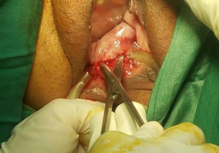This clinical photograph displays an intraoperative view of a gynecological surgical procedure within the vaginal canal. The primary focus is the dissection of an impacted ring pessary from the vaginal mucosa. Metzenbaum (Metz) scissors are being utilized to excise thick, pale, fibrotic bundles of tissue that have formed over and entrapped the pessary. The vaginal mucosa appears thin, erythematous, and atrophic, consistent with severe urogenital atrophy. There is moderate bleeding at the surgical site where the fibrotic tissue is being incised. A portion of the pessary ring is visible near the lateral wall of the vagina, and a flexible drainage tube or catheter is positioned within the field. The surgical site is bordered by the labia and draped with green sterile cloths, with the surgeon's gloved hands visible at the bottom of the frame. This image demonstrates the clinical complication of pessary impaction and the necessary surgical intervention to release the device from hypertrophic vaginal scarring.