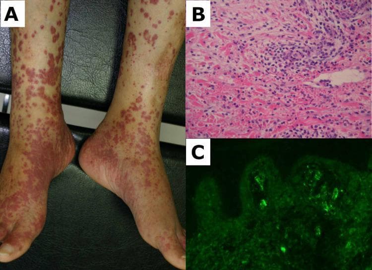 This composite image illustrates the clinical, histological, and immunopathological hallmarks of IgA vasculitis (Henoch-Schönlein purpura). Panel A is a clinical photograph of the bilateral lower limbs showing extensive palpable purpura. The lesions are erythematous to purplish-red macules and papules, ranging from pinpoint petechiae to confluent patches, predominantly involving the feet, ankles, and shins. Panel B presents a skin biopsy specimen stained with hematoxylin and eosin (H&E) at high magnification, demonstrating leukocytoclastic vasculitis. Key features include a dense perivascular neutrophilic infiltrate, leukocytoclasis (nuclear dust), and extravasated erythrocytes within the dermis. Panel C shows a direct immunofluorescence (DIF) micrograph of the dermis, highlighting characteristic granular immunoglobulin A (IgA) deposits within the superficial dermal capillary walls, appearing as bright apple-green fluorescence. This educational sequence correlates the gross dermatological presentation of small-vessel vasculitis with its underlying microscopic vascular damage and specific immune complex deposition pattern.