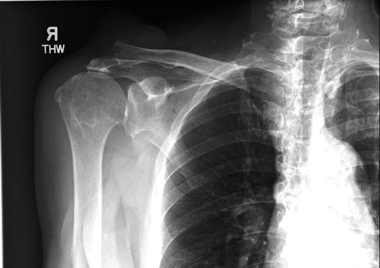 Anteroposterior (AP) radiograph of the right shoulder demonstrating classic hallmarks of rotator cuff arthropathy. The primary finding is a 'high-riding' humerus, characterized by the superior migration of the humeral head relative to the glenoid fossa. This leads to a marked reduction in the acromiohumeral distance, with the humeral head positioned closely beneath the inferior surface of the acromion. Adjacent to the acromioclavicular joint (ACJ), there is a prominent, well-defined soft tissue density suggesting significant swelling or a cystic mass. The bony structures show degenerative changes, including subchondral sclerosis and potential osteophyte formation. These visual features are pathognomonic for a chronic, massive rotator cuff tear where the loss of the inferior force couple allows the deltoid to pull the humerus superiorly. The associated ACJ soft tissue mass in this clinical context likely represents a Geyser sign, indicating a synovial cyst communicating with the glenohumeral joint due to chronic cuff deficiency.