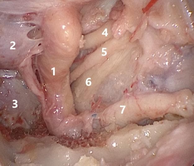 This endoscopic clinical photograph displays the microsurgical anatomy of the cavernous sinus and parasellar region, likely viewed via a transnasal transpterygoid approach. The central landmark is the cavernous segment of the internal carotid artery (1), shown as a prominent, vertically oriented vessel. To its medial side are the hypophysis (2) and the inferiorly positioned clivus (3). The lateral wall of the cavernous sinus is dissected to reveal several cranial nerves in their anatomical order. From superior to inferior, the oculomotor nerve (4), the abducens nerve (5), and the ophthalmic branch (V1) of the trigeminal nerve (6) are visible, following a longitudinal course. The maxillary branch (V2) of the trigeminal nerve (7) is seen most inferiorly and laterally, emerging toward the pterygopalatine fossa. The image serves as an educational reference for skull base surgery, illustrating the critical spatial relationships between vascular structures and cranial nerves during surgical decompression or tumor resection in Meckel's cave and the cavernous sinus.