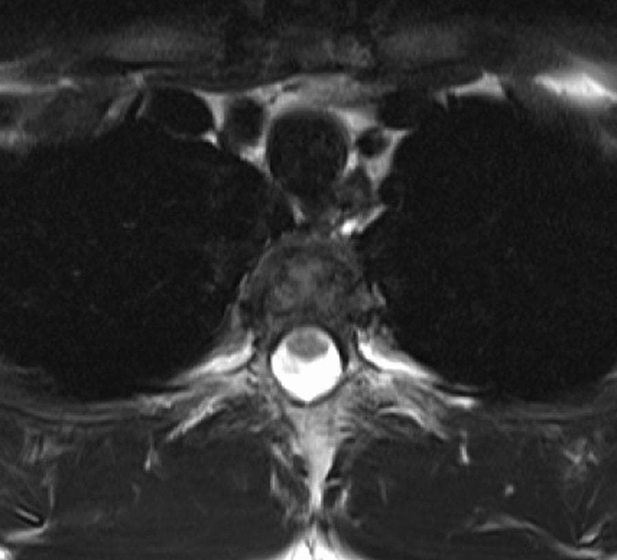 This diagnostic image is a transverse T2-weighted MRI of the thoracic spine at the Th4-5 vertebral level, specifically showing post-surgical follow-up. The central feature is the spinal canal, where the cerebrospinal fluid (CSF) exhibits a high signal intensity (bright white), clearly delineating the spinal cord, which appears as a lower-intensity (gray), rounded structure. The image demonstrates the restoration of the anterior subarachnoid space, with a visible layer of CSF separating the anterior surface of the spinal cord from the posterior aspect of the vertebral body. Anatomically, the vertebral body is positioned anteriorly, the spinal canal is central, and the posterior elements are visible behind the cord. This imaging modality and view are used in neurosurgery and orthopedics to assess spinal cord decompression, CSF flow, and positional changes of the cord within the thecal sac following procedures for conditions such as tethered cord syndrome or disc herniation.