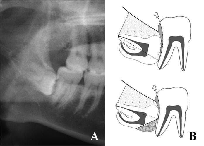 The visual consists of two parts: (A) a diagnostic orthopantomogram (OPG) and (B) a technical surgical sketch, both illustrating a high-risk mandibular third molar (tooth 48) impaction. Image A shows tooth 48 in a horizontal position, deeply embedded within the mandibular bone with its crown directly abutting the distal surface of the adjacent second molar. The roots are positioned posteriorly, and the crown is partially obscured by the alveolar bone, classified as risk degree III. Image B provides a schematic of the same tooth demonstrating 'Risk Degree III' surgical considerations. The sketch illustrates that even after a half-crown sectioning procedure and complete bone removal (indicated by stippled areas), high resistance remains from the adjacent second molar. A dashed line indicates the long axis of the impacted tooth, while a curved arrow indicates the required extraction pathway. Shaded regions highlight mechanical obstruction points. This content is designed for oral and maxillofacial surgery education, focusing on surgical planning for complex impactions involving high adjacent tooth resistance and the assessment of extraction pathways.