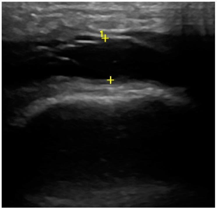 This diagnostic ultrasound image demonstrates a joint effusion, likely within the temporomandibular joint (TMJ) based on the clinical context of condylar assessment. The primary finding is an elongated, anechoic to hypoechoic fluid-filled space situated between the joint structures. This area of synovial effusion is dark and devoid of internal echoes, suggesting simple fluid without significant debris or hemorrhage. The bordering osseous surfaces are characterized by hyperechoic, bright curvilinear lines representing the bony cortex. Yellow crosshair markers (labeled '1+') indicate specific measurement points for the width of the joint space or the depth of the effusion. The bone surface appears relatively smooth and regular in the visible segment, though the field of view is localized. This imaging modality is used in rheumatology and dentistry to detect joint inflammation, synovitis, and internal derangements by visualizing soft tissue components and cortical integrity that are not visible on standard radiographs.