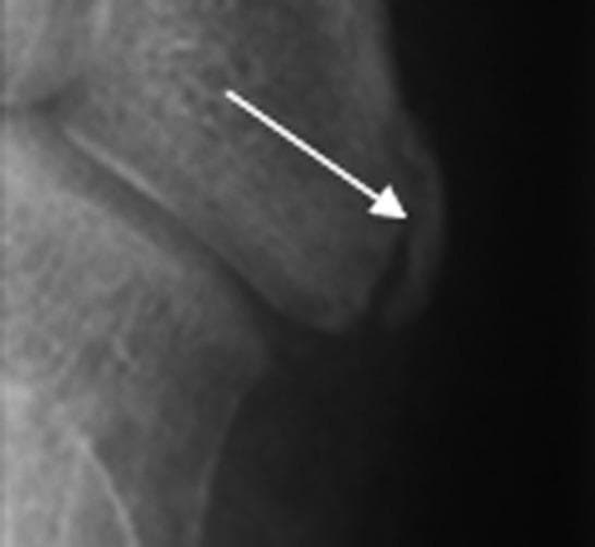 A close-up diagnostic X-ray of the base of the fifth metatarsal in a 13-year-old male, demonstrating maturity stage 2 of ossification. The radiograph shows the proximal epiphysis as a small, thin radio-opaque ossified flake located lateral to the metatarsal body. An arrow indicates the site where the epiphysis is commencing fusion with the metaphysis. Distinct radiolucent spaces are visible between the epiphyseal flake and the metaphyseal surface, signifying incomplete fusion. The lateral aspect of the metatarsal body appears slightly flattened but is beginning to show rounding as the skeletal maturation progresses. This image serves as a clinical reference for assessing pediatric skeletal age and forensic age estimation based on foot development patterns.