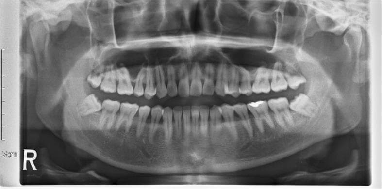 A pre-operative human panoramic radiograph (orthopantomogram) providing a comprehensive view of the maxilla, mandible, and dental arches. The image demonstrates bilateral impacted mandibular third molars (teeth 38 and 48). Both third molars exhibit a horizontal angulation according to Winterโs classification, with their occlusal surfaces directed toward the distal roots of the adjacent second molars. Based on the Pell-Gregory classification, the teeth show a significant ramus relationship, positioned partly or mostly within the ascending ramus of the mandible. The general dentition is intact, showing visible radiopaque dental restorations on the mandibular left first molar. Surrounding anatomical structures, including the maxillary sinuses, nasal cavity, mandibular canal, and temporomandibular joints (TMJs), are visualized. The radiograph is used in oral and maxillofacial surgery for assessing the depth, angulation, and proximity of impacted teeth to the inferior alveolar nerve prior to surgical extraction.