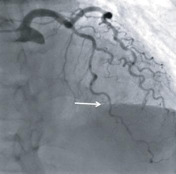 This diagnostic coronary angiogram, captured in the right anterior oblique (RAO) cranial view, illustrates the anatomy and pathology of the left coronary system. The image displays a diffusely diseased and calcified left anterior descending artery (LAD). A white arrow points to an intermediate stenosis located in the midportion of the LAD, characterized by a visible narrowing of the luminal diameter compared to the proximal and distal segments. The distal LAD and several diagonal branches show subtle tortuosity and signs of atherosclerosis. The left circumflex artery (LCx) is also visible, exhibiting mild luminal irregularities. This clinical imaging is essential for evaluating coronary artery disease and determining the functional significance of lesions, often in conjunction with physiological assessments like Fractional Flow Reserve (FFR). It serves as an educational tool for cardiology training, specifically in identifying stenotic lesions and interpreting angiographic projections during cardiac catheterization.