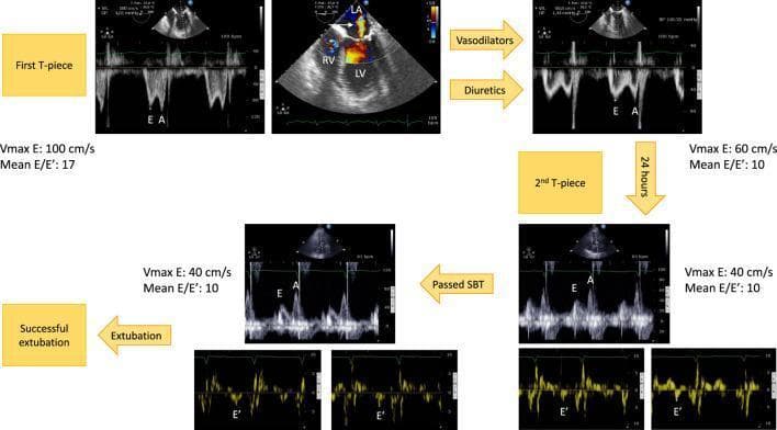 This composite diagnostic image illustrates hemodynamic monitoring using transesophageal echocardiography (TEE) to manage weaning-induced pulmonary edema (WIPO) in a patient with ischemic heart disease. The figure follows a clinical progression from a failed 'First T-piece' trial to 'Successful extubation'. Key visual components include: 1) Pulsed-wave mitral Doppler tracings showing E and A waves, 2) Tissue Doppler imaging (TDI) showing E' waves, and 3) Color Doppler of the mitral valve. In the initial phase, elevated LV filling pressures are evidenced by a Vmax E of 100 cm/s and a mean E/E' ratio of 17, alongside mild functional mitral regurgitation (labeled LA, RV, LV with a white arrow). Following pharmacological intervention with vasodilators and diuretics, subsequent panels demonstrate a therapeutic response: Vmax E decreases to 60 cm/s and eventually 40 cm/s, with the mean E/E' ratio stabilizing at 10. These echocardiographic markers indicate a reduction in LV filling pressure and successful normalization of hemodynamics, which facilitated a successful second spontaneous breathing trial (SBT) and extubation. This figure serves as an educational guide for using TEE to tailor therapy for difficult-to-wean ventilated patients.