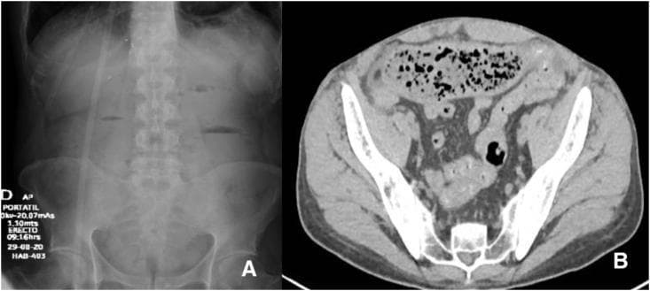 This composite educational resource consists of two diagnostic images illustrating Distal Intestinal Obstruction Syndrome (DIOS). Image A is an erect anteroposterior abdominal x-ray showing multiple horizontal air-fluid levels within dilated small bowel loops, accompanied by a notable absence of gas in the rectum and distal colon, characteristic of a mechanical bowel obstruction. Image B is an axial contrast-enhanced computed tomography (CT) scan of the abdomen at the level of the pelvis. It reveals the 'small bowel feces sign,' characterized by the presence of particulate matter and gas bubbles mimicking the appearance of colonic feces within dilated loops of the mid-jejunum. This finding indicates a transition zone and stasis secondary to luminal impaction. Together, these images demonstrate the radiographic and tomographic hallmarks of a proximal to mid-small bowel obstruction caused by inspissated fecal material, a condition frequently associated with cystic fibrosis and significant for diagnostic triage in surgical and internal medicine curricula.